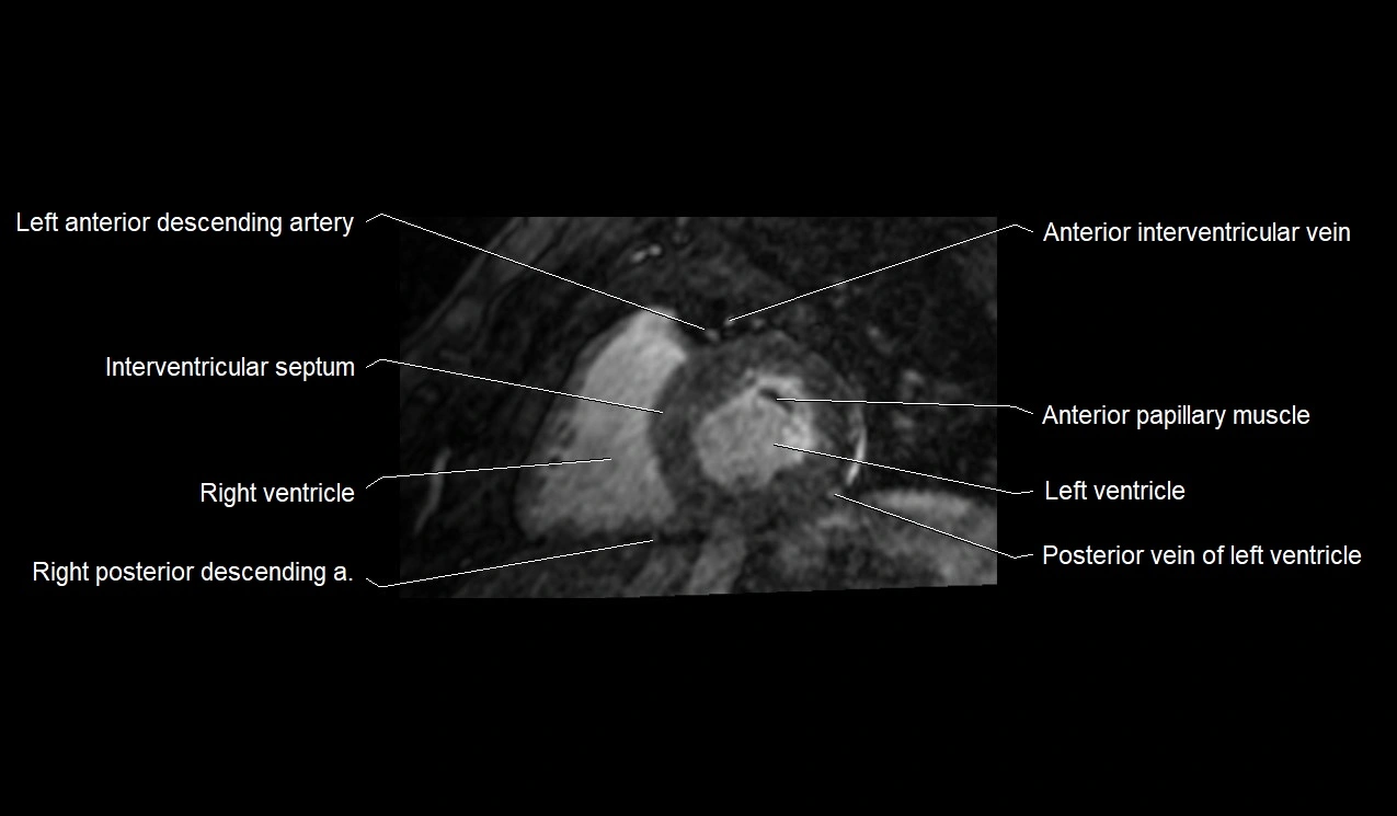 MRI heart and coronary arteries short axis anatomy image 24.webp